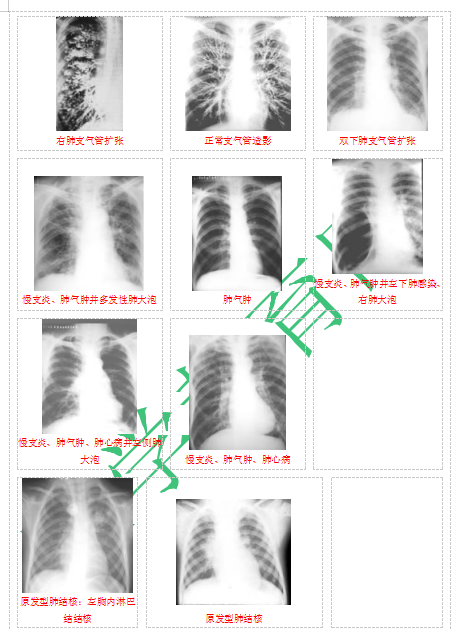 快收藏！臨床助理醫(yī)師實(shí)踐技能62個(gè)胸片（圖片診斷）