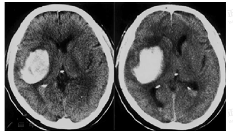 男55歲，左側(cè)肢體偏癱4小時(shí)，有高血壓史，診斷為
